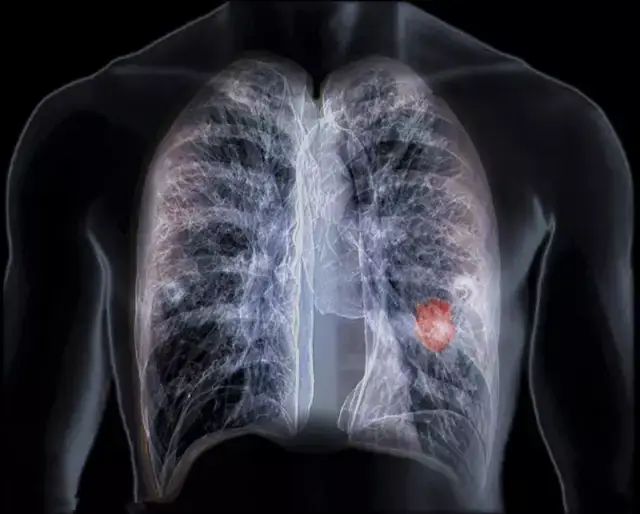 肺癌晚期患者还能活多久?
