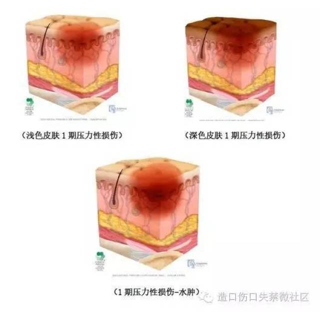 npuap最新版压力性损伤定义与分期(中文版)