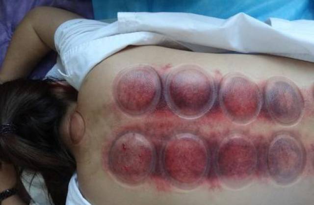 拔罐为什么吸不紧 82c86d745a03458c8ff3a6d10100b317.jpeg