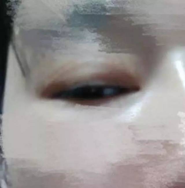 爱美要谨慎!女子到南宁整形失败,要求退款遭