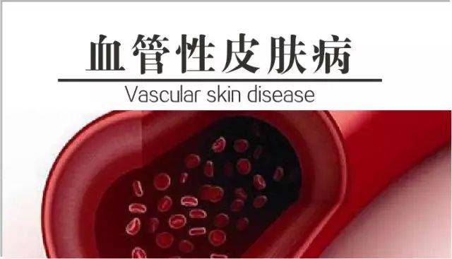 直播预告 |听普雄明教授说荨麻疹性血管炎