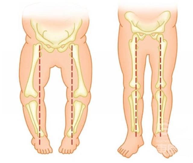 宝宝不会是罗圈腿吧? 这腿怎么老伸不直呢?会不会是尿不湿惹的祸?