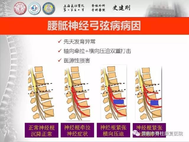 异常,但双下肢麻木或疼痛症状明显,严重患者查体还会出现双膝反射亢进