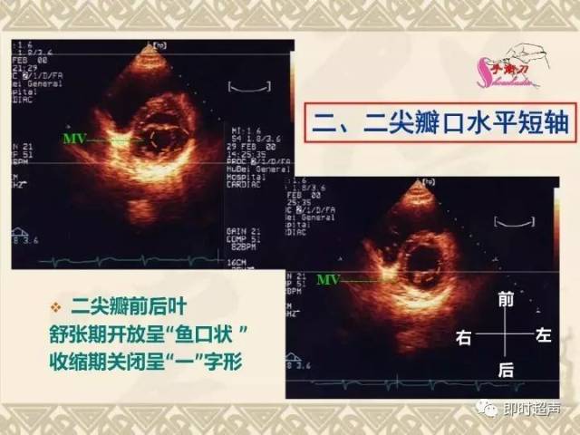 超声心动图常用切面的打法图解