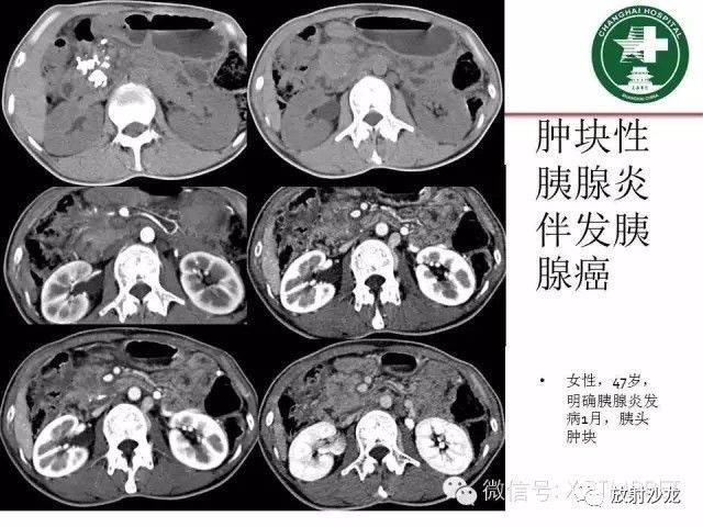 肿块性胰腺炎影像诊断和鉴别诊断