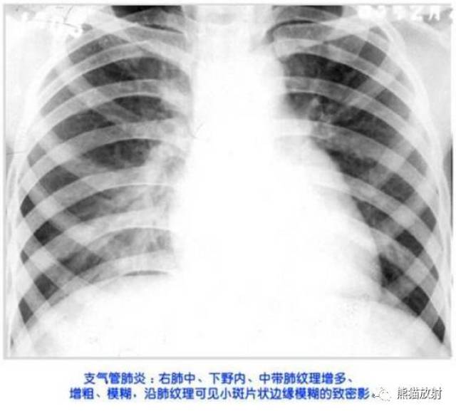 【x线诊断要点】大叶性肺炎,支气管肺炎,球形肺炎,机化性肺炎,炎性假