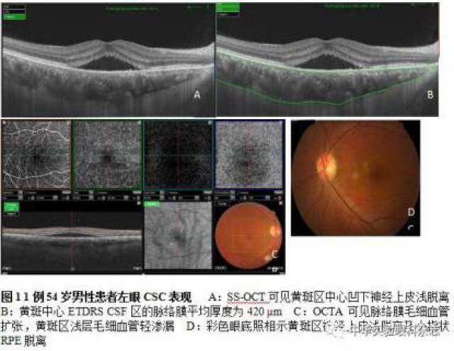 ccos2017丨张新媛教授黄斑区肥厚型脉络膜疾病谱