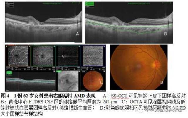 肥厚型脉络膜新生血管性疾病(pachychoroid neovascularization,pnv)