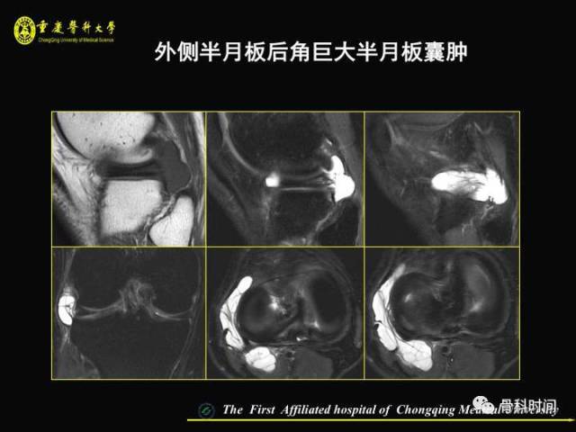 精彩幻灯:膝关节半月板 mri 入门,看这篇就够了!