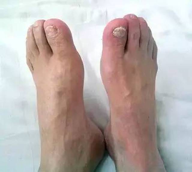 央视:腿麻脚痛怎么办?三七帮你忙!血管是如何堵塞的?