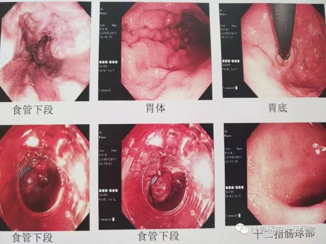 微·医讯|吐鲁番市人民医院成功开展食管胃底静脉曲张