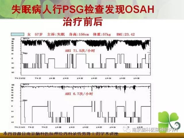 多导睡眠监测在神经科疾病中的临床应用