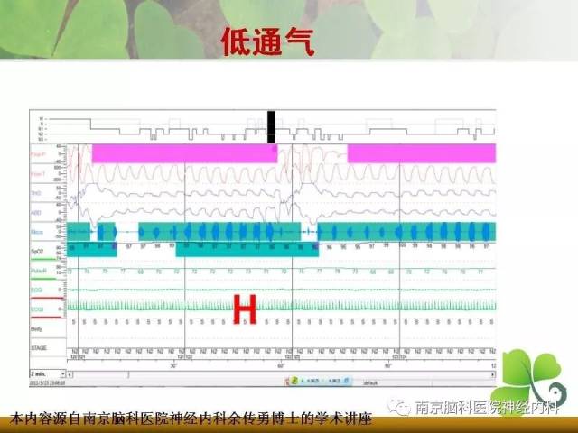 多导睡眠监测在神经科疾病中的临床应用