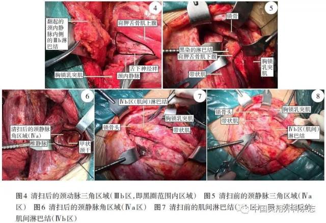 专题笔谈|甲状腺癌颈侧区淋巴结清扫局部解剖及临床应用