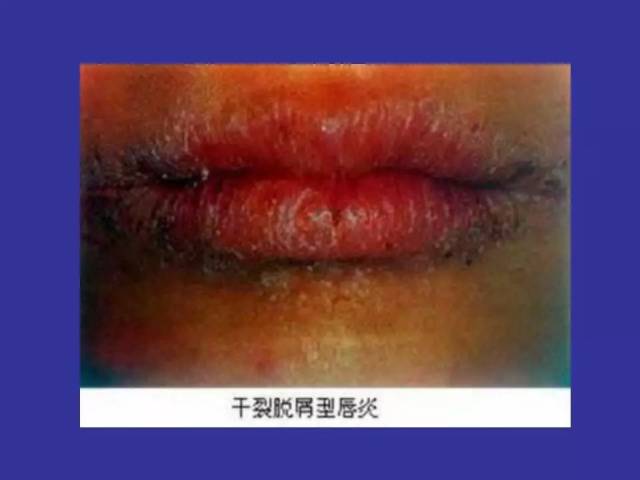 多图连载(四):口腔黏膜大疱类疾病及唇舌疾病图示