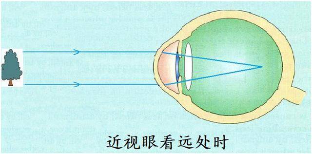 那些我们经常听到的解决近视的方法,原理你都摸清了吗?