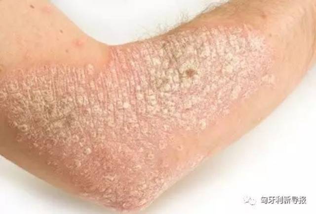 银屑病( psoriasis )是皮肤科一种常见的慢性顽固性皮肤病,其发病