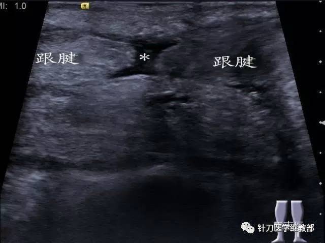 病例2,痛风:肌骨超声可显示该患者掌指关节滑膜腔内痛风石的形成*