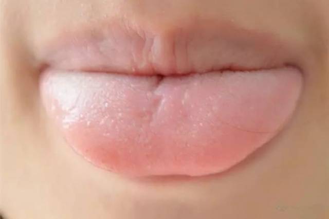 舌头起泡是什么原因?