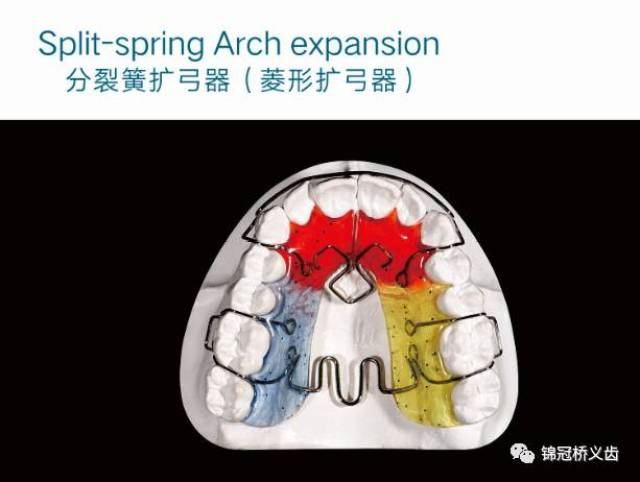 【干货】活动矫正扩弓器