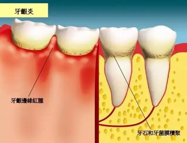 小心牙龈萎缩找上你!