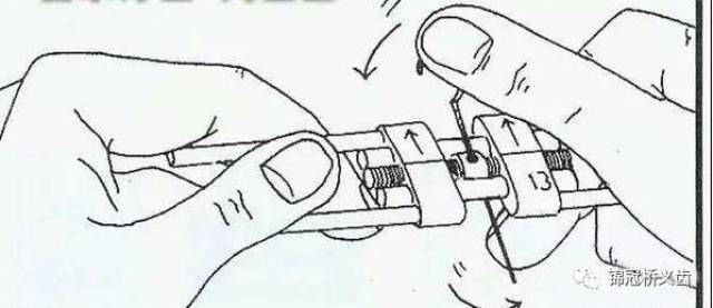 【干货】活动矫正扩弓器