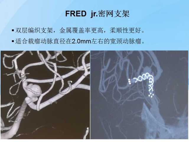 不同类型颅内支架在脑动脉瘤治疗中的应用