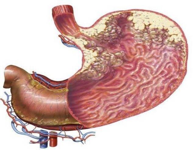 身体有4个反应,表明胃癌来了,而预防胃癌要趁早