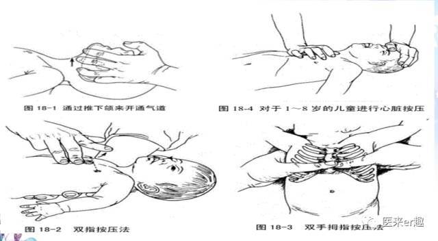 2,清理呼吸道,开放气道(a) 常用压额抬颏法开放气道,如果颈部有骨折或