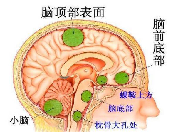 脑肿瘤gdp(3)