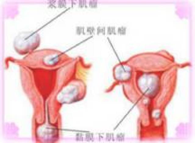 什么情况下要切除子宫肌瘤 e36132472dab43878235e20e04bc4a78.jpeg