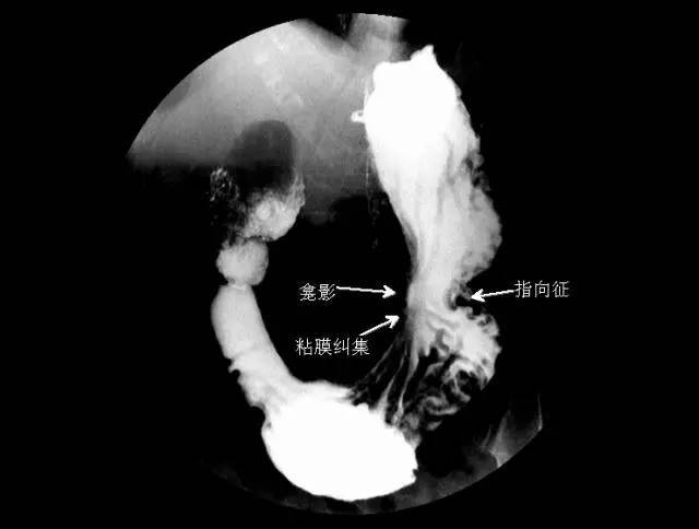 5 分钟读懂消化道造影片(胃篇)