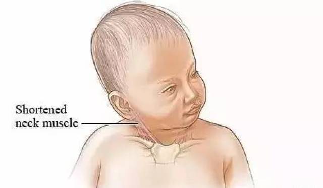 宝宝斜颈会导致偏头,大小脸!及时发现和纠正治疗很关键!