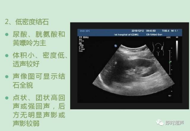 肾结石超声诊断及鉴别