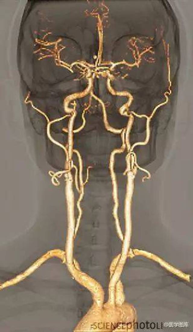 大脑供血动脉3d扫描ct成像
