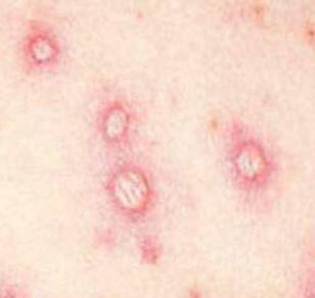 疱疹性咽峡炎:多由柯萨奇a组病毒引起.