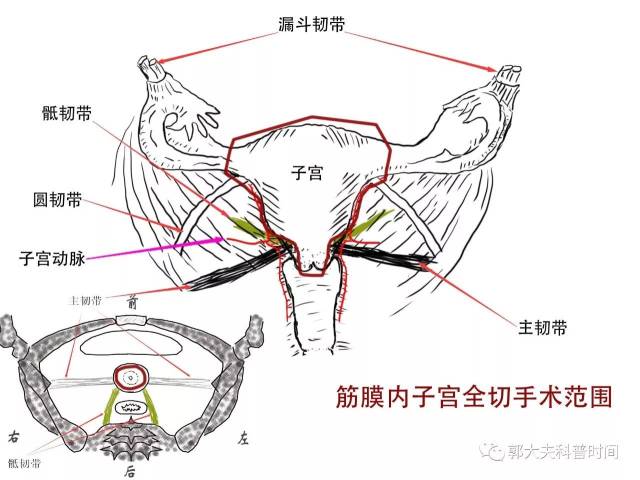 关于子宫切除的小秘密(一)——切除范围