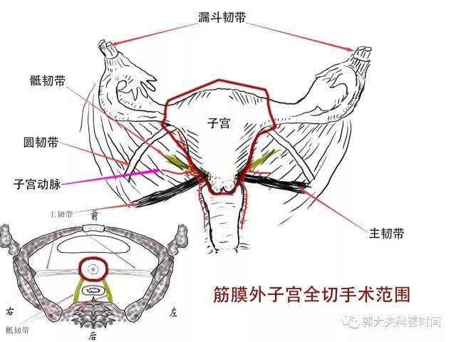 紧贴子宫切断子宫主,骶韧带和阴道穹窿.