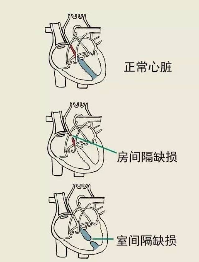 出生时就有心脏结构的异常称为先天性心脏病,如房间隔缺损,室间隔