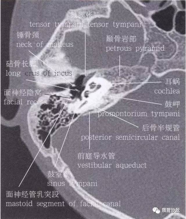 【解剖】颞骨大体解剖 轴位及冠状位ct断层图像