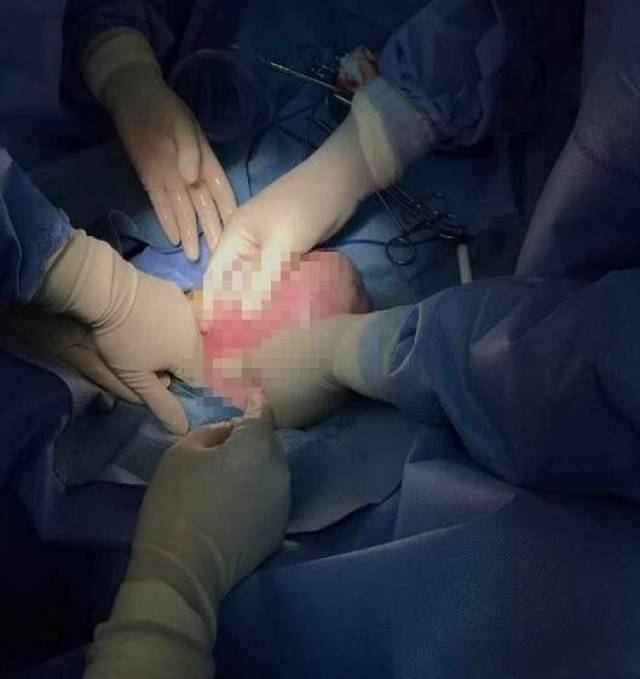 杭州二胎妈妈子宫掉进阴道,遭遇罕见大出血!从医30年的产科主任也是首次遇到