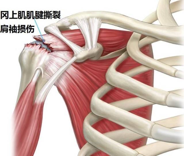 肩袖撕裂后往往会导致肩关节疼痛,活动功能受限.