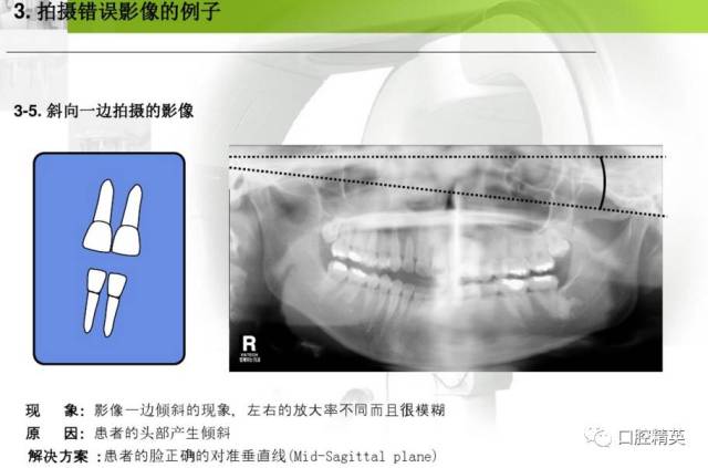 牙片机拍摄程序定位