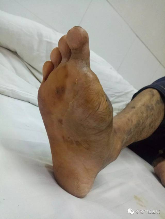 糖尿病足坏死的保肢治疗奇迹!