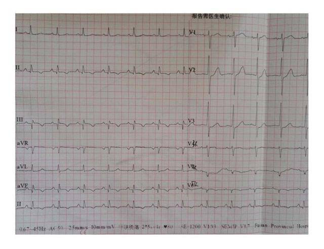 出现胸痛伴心电图ST段弓背向上抬高,为何?