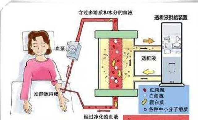 慢性肾病患者什么时候开始透析?_手机搜狐网