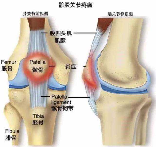 膝盖前侧疼痛,但无法准确定位