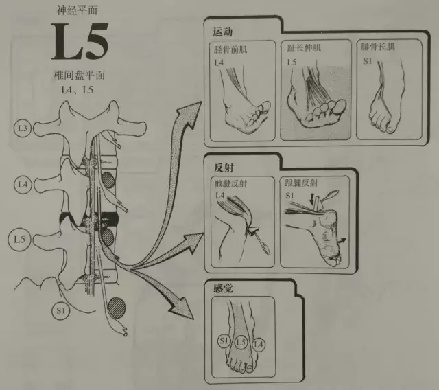 l4/5椎间盘突出累及l5神根,l4/5节段椎间盘突出在腰椎中的第二常见