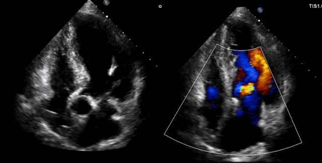 患者心脏彩超