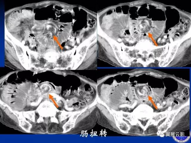 急性绞窄性肠梗阻ct诊断